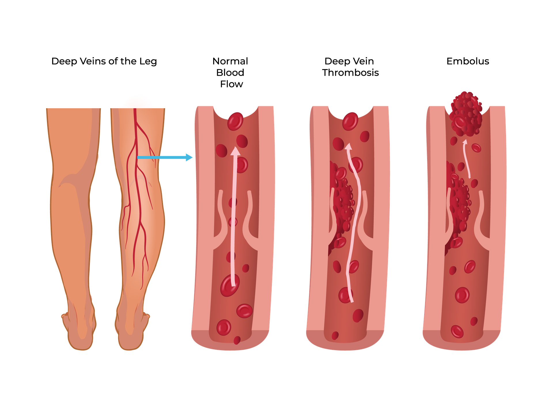 Deep Vein Disease and Chronic DVT