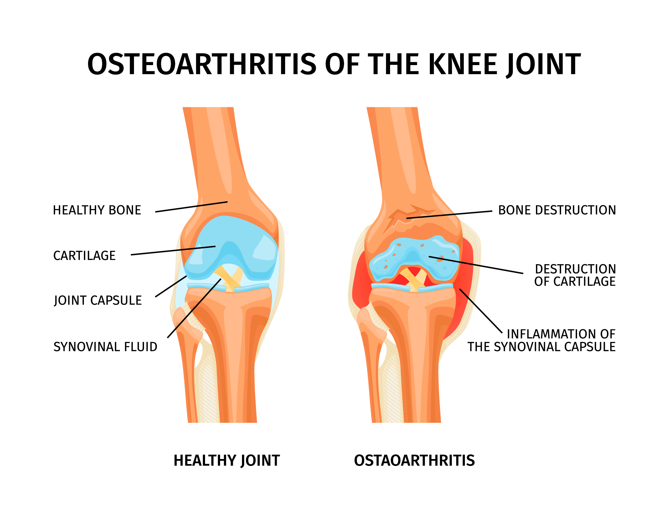 Knee Osteoarthritis