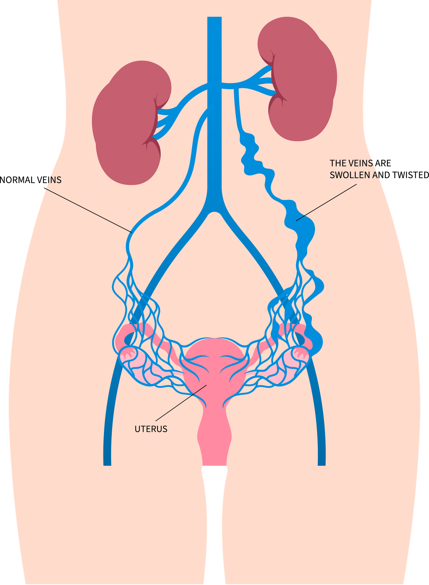 Pelvic Venous Disease